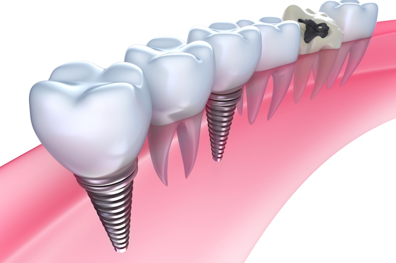 implantologia-en-getafe