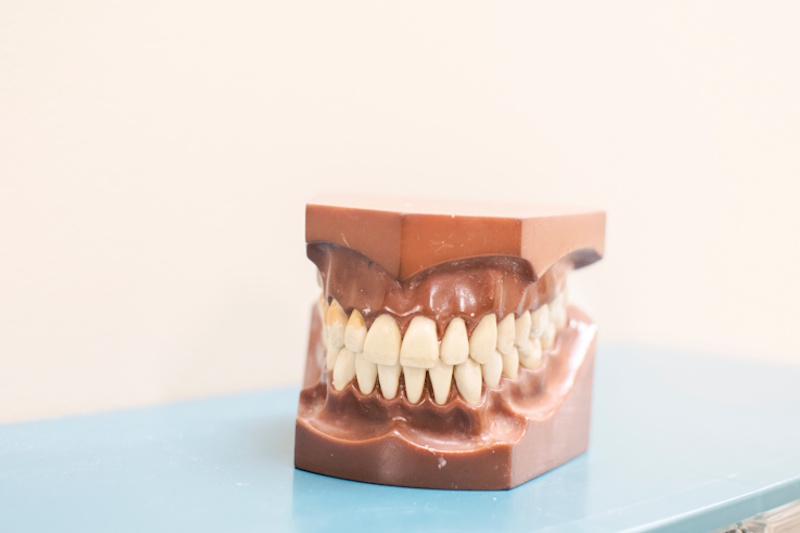 protesis-parciales-removibles