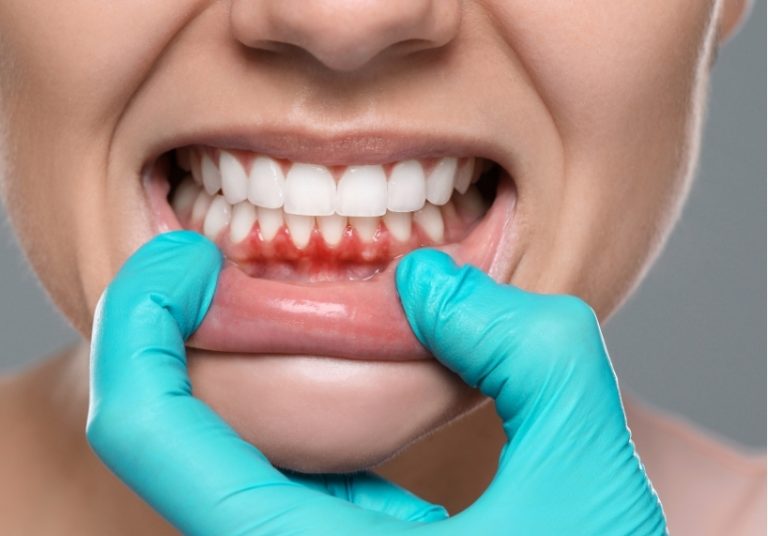 sabes-que-es-la-cirugia-estetica-de-la-encia