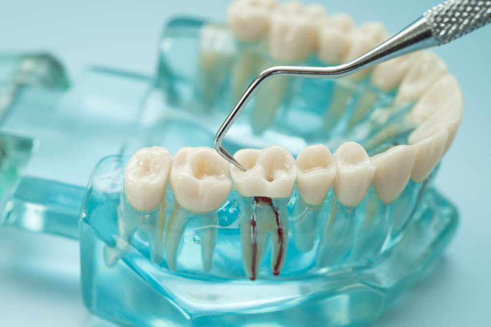 como es la intervencion endodoncia