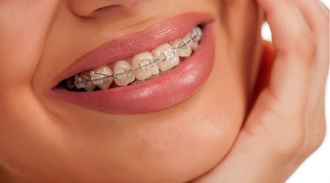 ortodoncia estetica en getafe