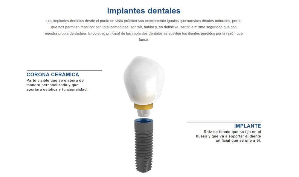 que son los implantes