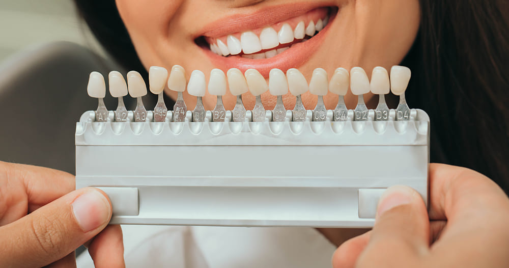 proceso de colocacion de carillas dentales en la clinica dental