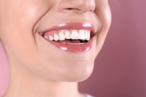 tipos de carillas dentales de porcelana y composite estetica dental